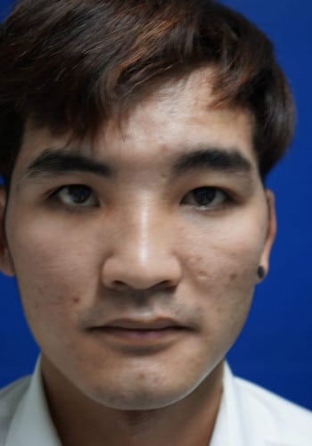 After Image: Craniofacial Tumor (Fibrous Dysplasia) - front