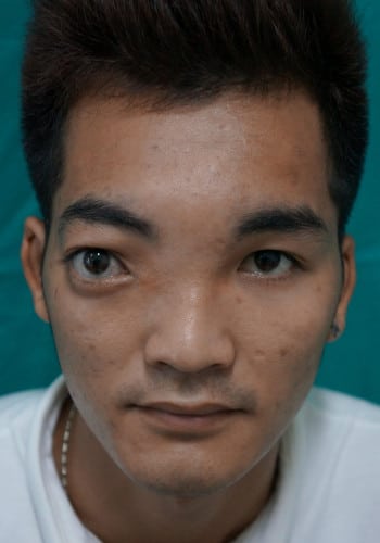 Before Image: Craniofacial Tumor (Fibrous Dysplasia) - front