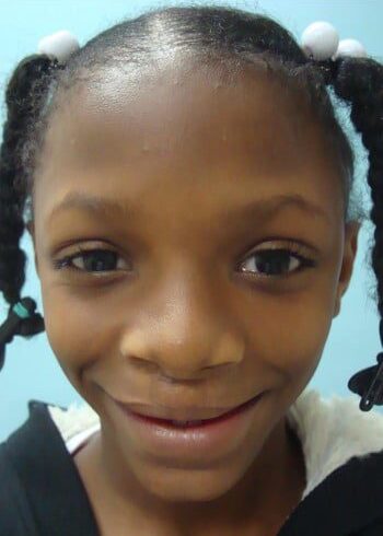 After Image: Cleft Lip - front