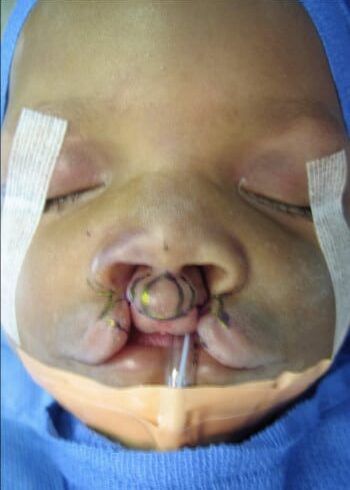 Before Image: Cleft Lip - front
