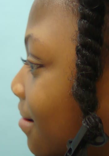 After Image: Cleft Lip - left-side