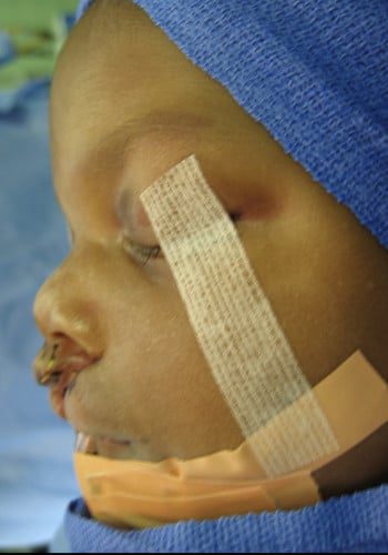 Before Image: Cleft Lip - left-side