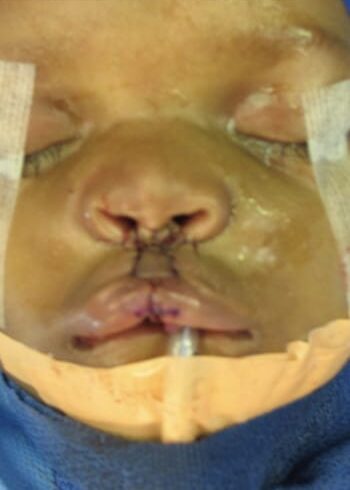 After Image: Cleft Lip - front