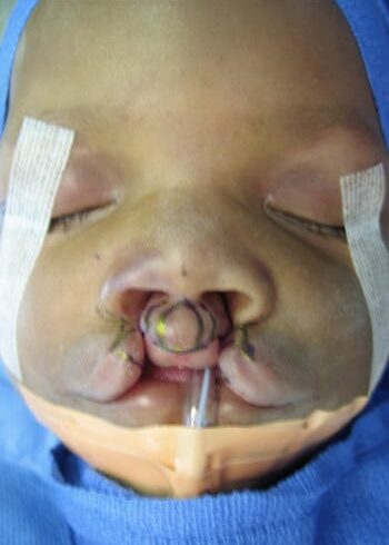Before Image: Cleft Lip - front