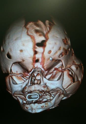 After Image: Craniosynostosis - front