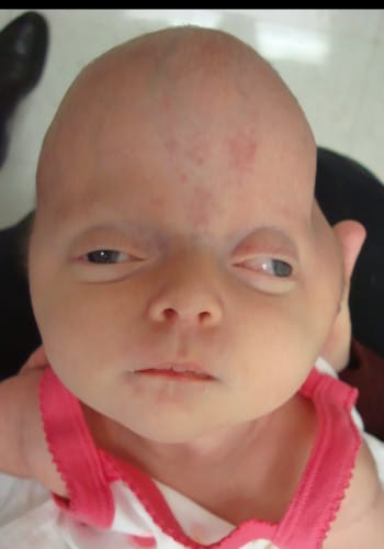 Before Image: Craniosynostosis - front