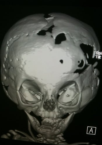 After Image: Craniosynostosis - front