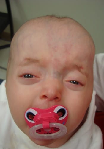 Before Image: Craniosynostosis - front