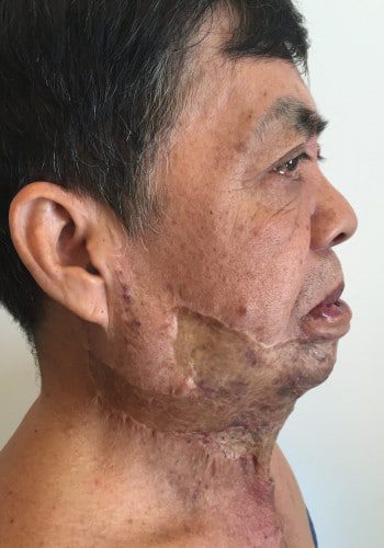 After Image: Venous Malformation - right-side