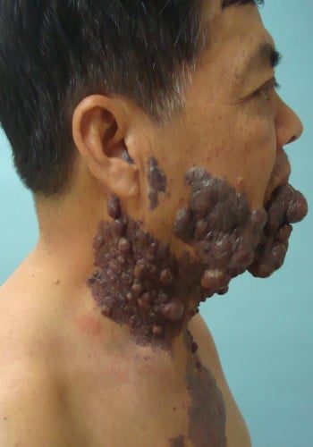 Before Image: Venous Malformation - right-side