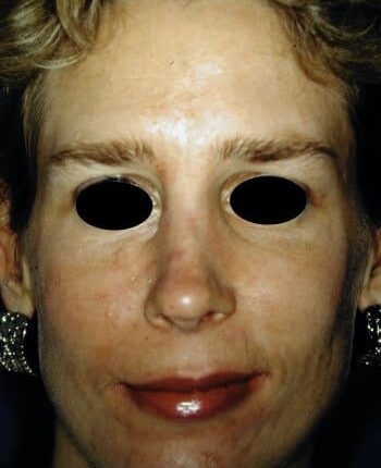 After Image: Facial Fractures - front
