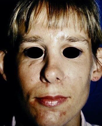 Before Image: Facial Fractures - front