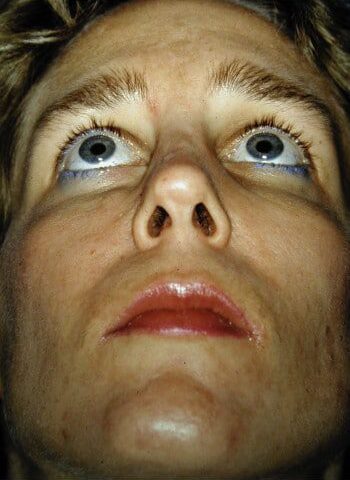 After Image: Facial Fractures - front