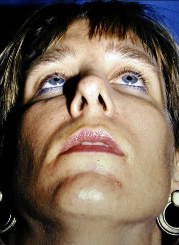 Before Image: Facial Fractures - front