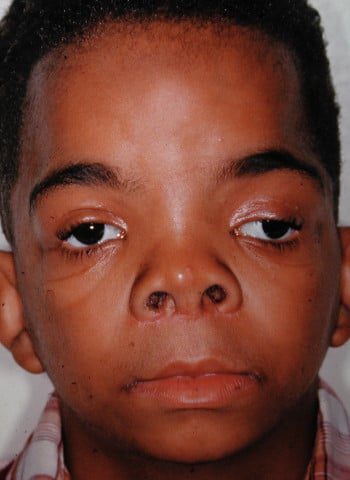 After Image: Craniosynostosis - front