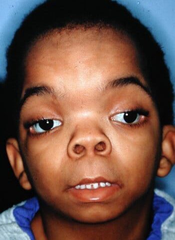 Before Image: Craniosynostosis - front
