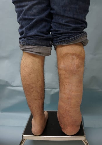 After Image: Neurofibromatosis Case Study 22 – Detailed Case Summary - back
