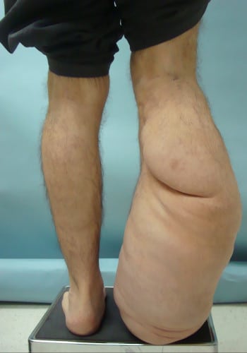 Before Image: Neurofibromatosis Case Study 22 – Detailed Case Summary - back