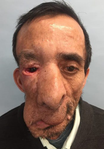 After Image: Neurofibromatosis Case Study 21 – Reconstructive Approach - front
