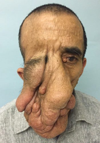 Before Image: Neurofibromatosis Case Study 21 – Reconstructive Approach - front