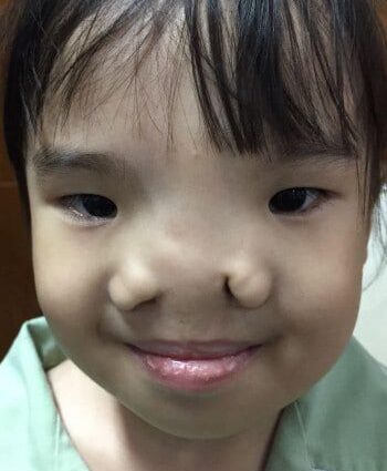 Before Image: Facial Cleft - front