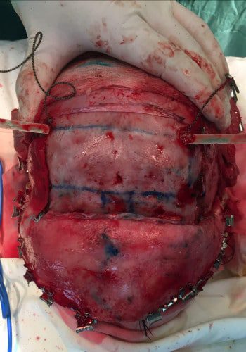 After Image: Facial Cleft - front