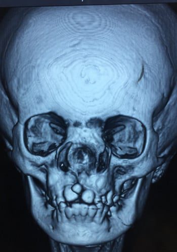 Before Image: Facial Cleft - front