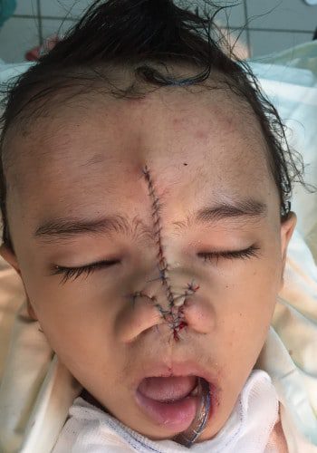 After Image: Facial Cleft - front