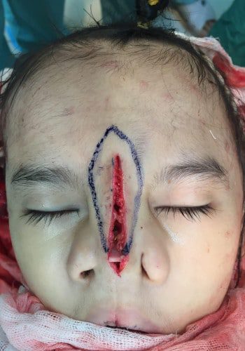 Before Image: Facial Cleft - front