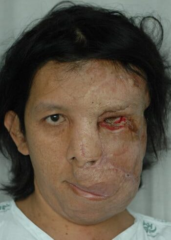 After Image: Neurofibromatosis Case Study 20 – Tumor Removal Insight - front