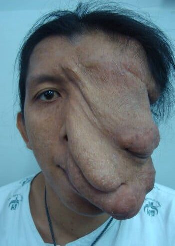 Before Image: Neurofibromatosis Case Study 20 – Tumor Removal Insight - front