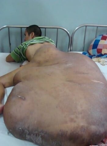 Before Image: Neurofibromatosis Case Study 19 – Targeted Reconstruction - front