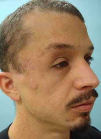 After Image: Neurofibromatosis Case Study 18 – Corrective Procedure - right-front-oblique