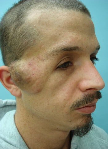 Before Image: Neurofibromatosis Case Study 18 – Corrective Procedure - right-front-oblique
