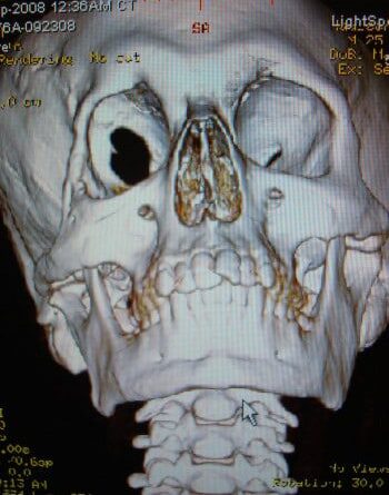After Image: Neurofibromatosis Case Study 18 – Corrective Procedure - front