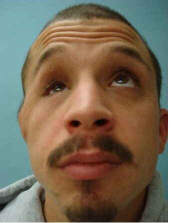 Before Image: Neurofibromatosis Case Study 18 – Corrective Procedure - front