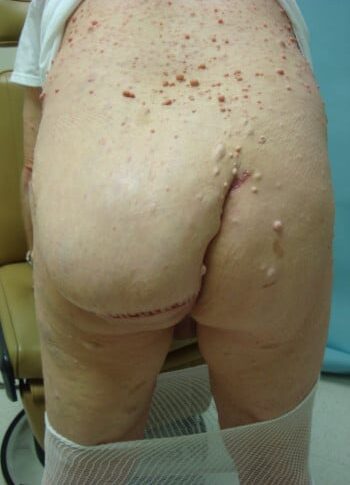 After Image: Neurofibromatosis Case Study 17 – Individual Case Review - back
