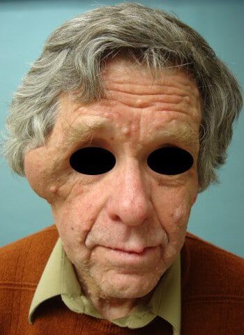 Before Image: Neurofibromatosis Case Study 16 – Functional Improvement - front
