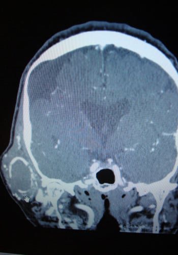 After Image: Neurofibromatosis Case Study 16 – Functional Improvement - front