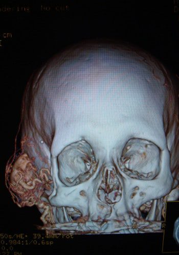 Before Image: Neurofibromatosis Case Study 16 – Functional Improvement - front