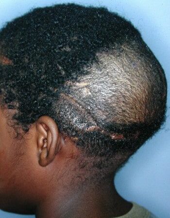 After Image: Craniofacial Tumor - left-side