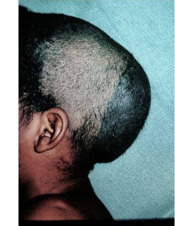 Before Image: Craniofacial Tumor - left-side