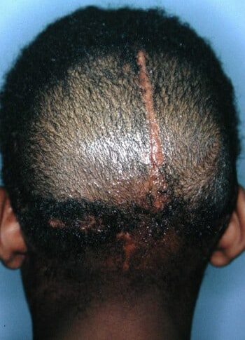 After Image: Craniofacial Tumor - back