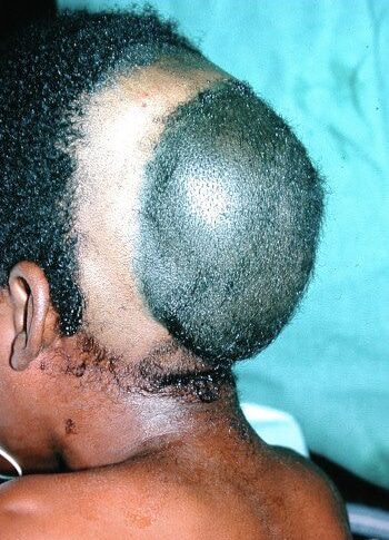 Before Image: Craniofacial Tumor - back