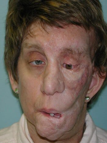 After Image: Neurofibromatosis Case Study 15 – Advanced Reconstruction - front