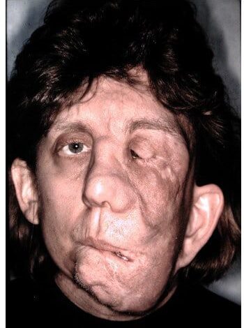 Before Image: Neurofibromatosis Case Study 15 – Advanced Reconstruction - front