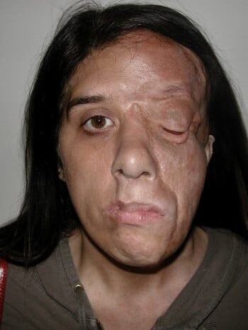 After Image: Neurofibromatosis Case Study 14 – Growth Removal - front