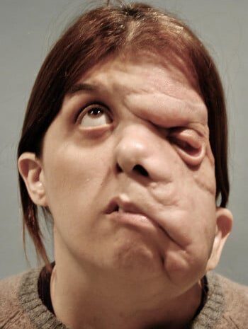 Before Image: Neurofibromatosis Case Study 14 – Growth Removal - front