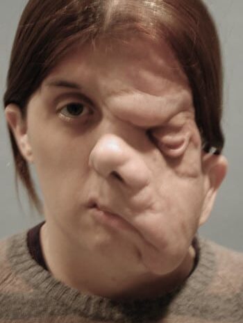 Before Image: Neurofibromatosis Case Study 14 – Growth Removal - front