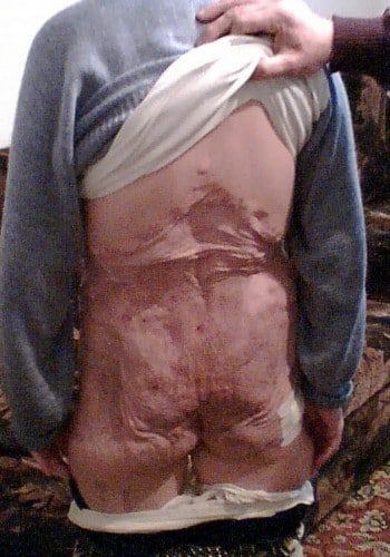 After Image: Neurofibromatosis Case Study 13 – Surgical Planning - back